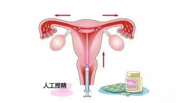 为什么都选择试管婴儿而不是人工受精?(图1)