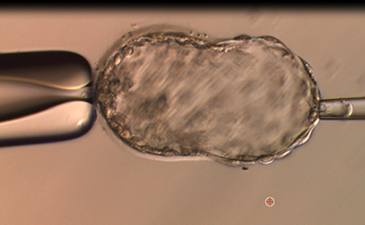试管婴儿的三种不同类型和体外受精周期中的各个步骤